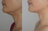 45-54 year old woman treated with Skin Tightening