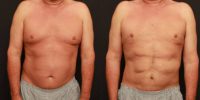 55-64 year old man treated with Liposculpture