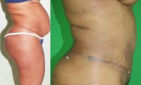 45-54 year old man treated with Tummy Tuck