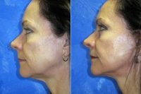 Doctor Edmund Fisher, MD, Bakersfield Facial Plastic Surgeon - Upper Blephs With Face And Neck Lift And Active FX