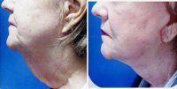 Doctor Elizabeth Whitaker, MD, FACS, Atlanta Facial Plastic Surgeon - 70 Year Old Woman Treated With Facelift