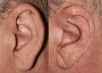 55-64 year old man treated with Ear Surgery