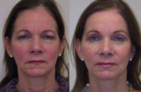 58 year old woman treated with Eyelid Surgery