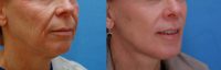 45-54 year old woman treated with Lip Lift, Skin Resurfacing and Facelift