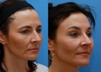 Young Woman Unhappy with Tired Appearance - Browlift and Upper Eyelid Lift
