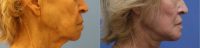 75 and up year old woman treated with Chin Implant