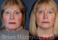 60 year-old female before and after Facelift and neck liposuction