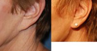 65-74 year old woman treated with Ear Lobe Surgery