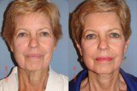 69 Year Old Female Facelift (Rhytidectomy)