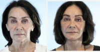 Doctor Henry Mentz, MD, FACS, Houston Plastic Surgeon - 58 Year Old Woman Treated With Facelift