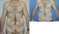 45-54 year old man treated with Body Lift