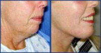 Neck Lift and Chin Implant