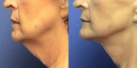 Necklift to correct loose skin