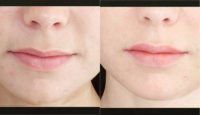 18-24 year old woman treated with Injectable Fillers