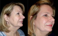 45-54 year old woman treated with Laser Resurfacing