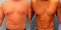25-34 year old man treated with Laser Liposuction