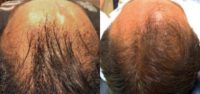 65-74 year old man treated with Hair Loss Treatment