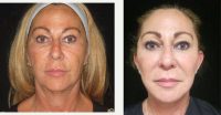 Doctor Johnny Franco, MD, FACS, Austin Plastic Surgeon - 58 Year Old Woman Treated With Eyelid Surgery