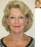 68 yo woman with a four year history of concerns regarding aging of her lower neck