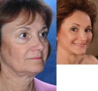 Facelift and Eyelid Surgery