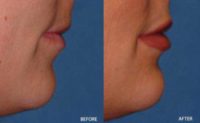 Juvederm Filler to Uppper and Lower Lip