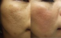 Acne Scar Removal Before and After Pictures