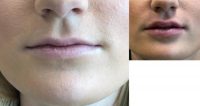 25-34 year old female with lip filler