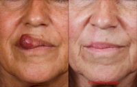 65-year-old woman with large lip lesion treated by surgical excision and repair