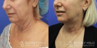 Woman treated with FaceTite