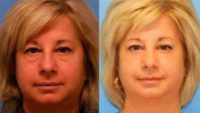 55-64 year old woman treated with Rhinoplasty
