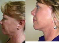 45-54 year old woman treated with Facelift, neck lift and upper eyelid surgery