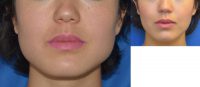 Buccal Fat Removal with Dysport (Botox) Jaw Slimming