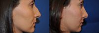 Female Patient Received Rhinoplasty to Remove Bump on Nasal Bridge