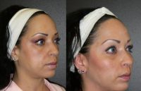 35-44 year old woman treated with Cheek Augmentation using silicone implants.