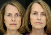 55-64 year old woman treated with Brow Lift and Upper Eyelid Surgery