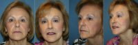69yo who Dr Prysi performed a Naples Endoscopic Composite Facelift/Browlift and Laser to Eyes and mouth