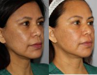 45-54 year old woman treated with Facelift Revision