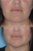 45-54 year old woman treated with Lip Reduction