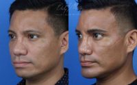 35-44 year old man treated with Chin Implant