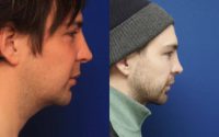 25-34 year old man treated with Revision Rhinoplasty