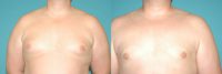 36 Year Old Male Gynecomastia Patient