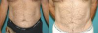64 Year Old Male- Abdominal Liposuction