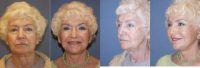 80yo who Dr Mark Prysi performed a Endoscopic composite facelift and Laser resurfacing to eyes and mouth