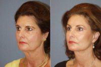 60yo Dr Mark Prysi performed Endoscopic Browlift, Endoscopic composite Facelift and Laser Resurfacing to Eyes and mouth