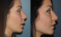 25-34 year old woman treated with Lip Lift