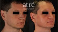Man treated with Revision Rhinoplasty