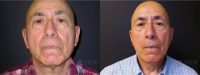 71 year old man treated with Facelift
