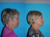 55-64 year old woman treated with Facelift, browlift, lower blepharoplasty and fat augmentation.