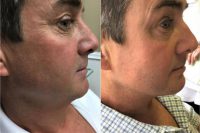 45-54 year old man treated with Kybella