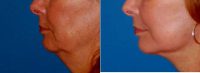 Doctor Ross A. Clevens, MD, Melbourne Facial Plastic Surgeon - Facelift Before